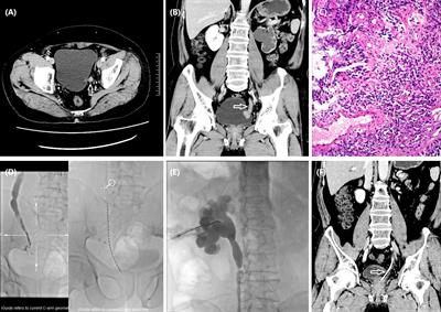 Safety and efficacy of iodine-125 seed strand for intraluminal brachytherapy on ureteral carcinoma